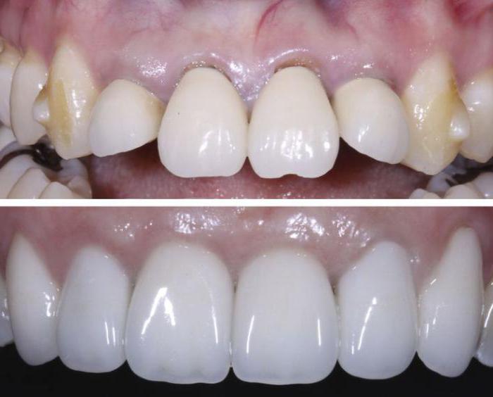 Separation of teeth: before and after