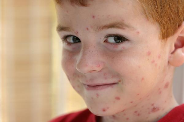 How are chickenpox treated in children? Symptoms and treatment recommendations