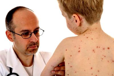 How does a child develop chickenpox and how to treat it?
