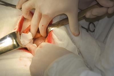 The abdominal operation to remove the cyst of the ovary and uterus