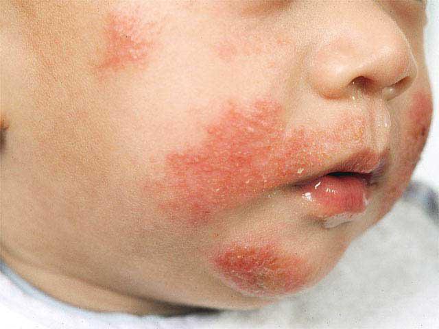 atopic dermatitis in children