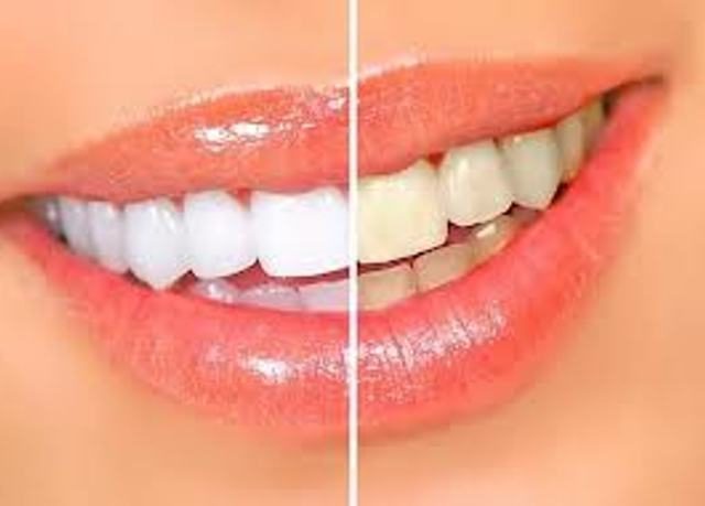 Self-bleaching of teeth with hydrogen peroxide.