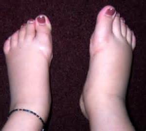 Strongly swollen feet: what to do and how to deal with the problem